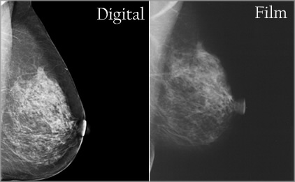 The Screening Mammography Furor: My Viewpoint as a Breast Surgeon